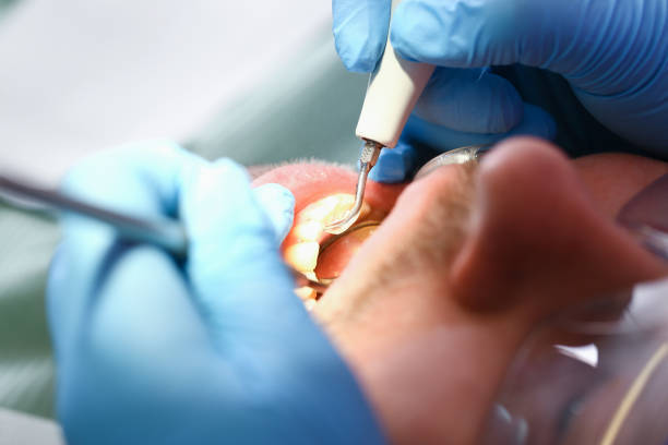 Best Emergency Root Canal Treatment in Shawnee, KS